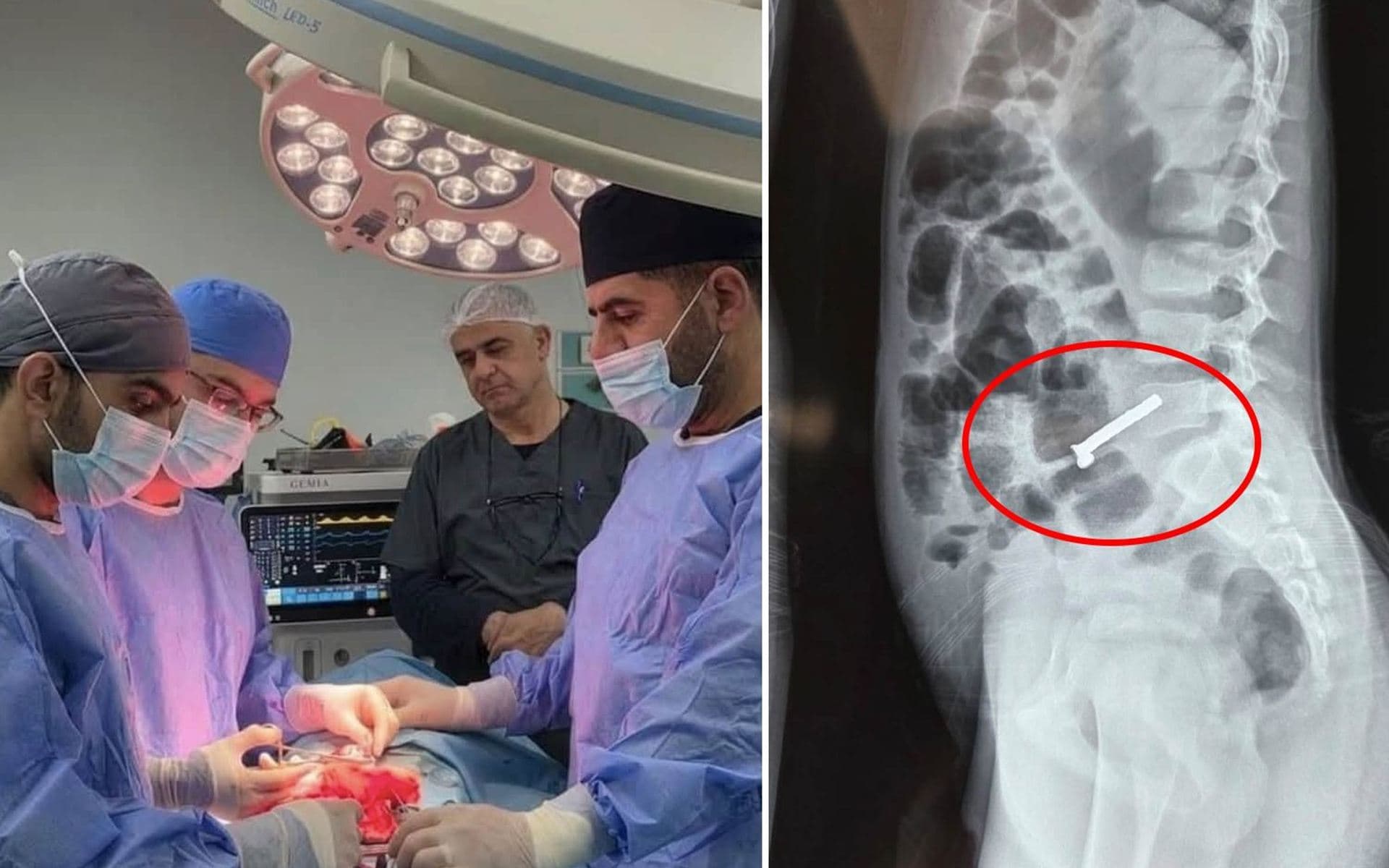 صورة من المغناطيس داخل امعاء الطفل